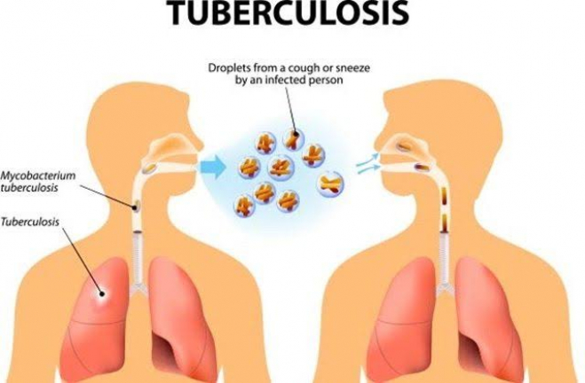Program Tracer Tuberkulosis (TB) Paru Resmi Diluncurkan